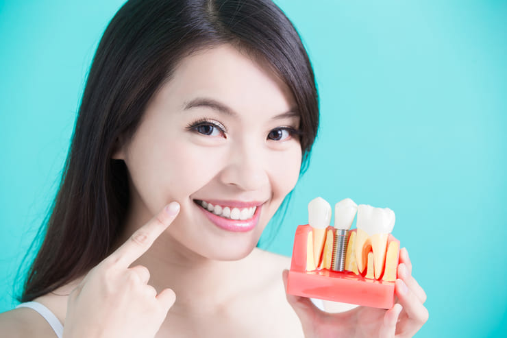 Implantes dentários: o que é, quais os principais tipos e como eles podem transformar a sua autoestima
