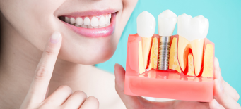 Implantes dentários: o que é, quais os principais tipos e como eles podem transformar a sua autoestima